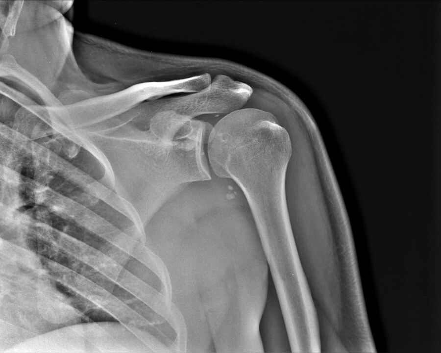 Radiografia de artrose da articulação do ombro de 2º grau de gravidade