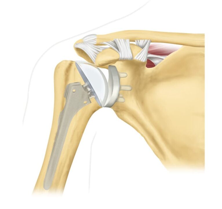 Substituição de uma articulação do ombro danificada por uma endoprótese
