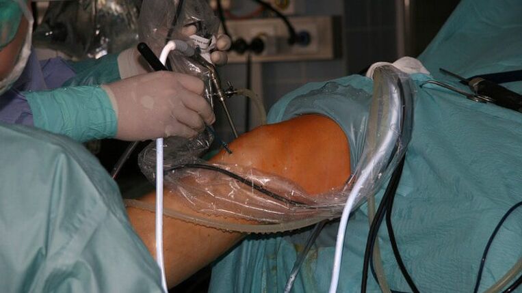 tratamento cirúrgico de artrose