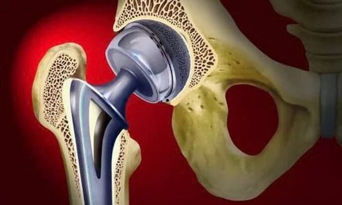 substituição da articulação do quadril para artrose