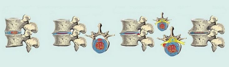 Estágios da formação de osteocondrose da coluna vertebral