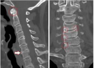A tomografia computadorizada mostra vértebras danificadas e discos de altura heterogênea devido à osteocondrose torácica