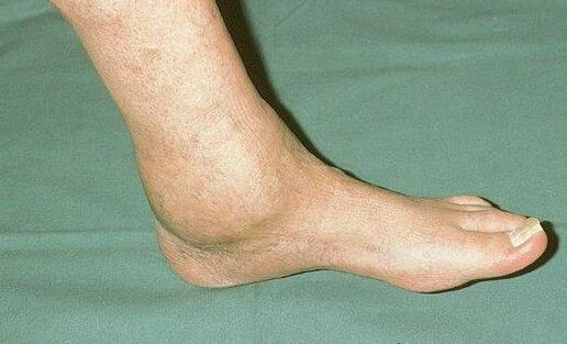inchaço do tornozelo com artrose