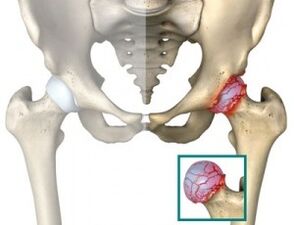 causas de atrose da articulação do quadril