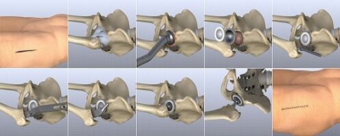 métodos de tratamento da artrose do quadril