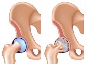 sintomas de artrose do quadril