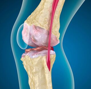 Artrose de joelho