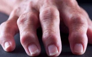 artrite reumatóide como causa de dores nas articulações